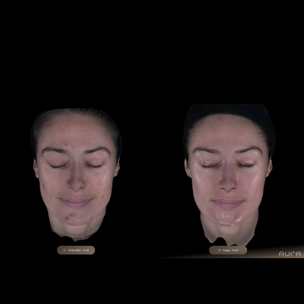 What to Expect After MOXI Laser Treatment: Downtime, Post-Care, and Results