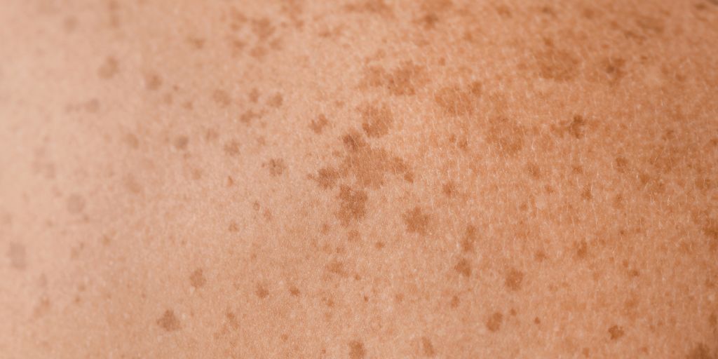 The Glow Guide to Melasma: What’s really behind the world’s most persistent pigment