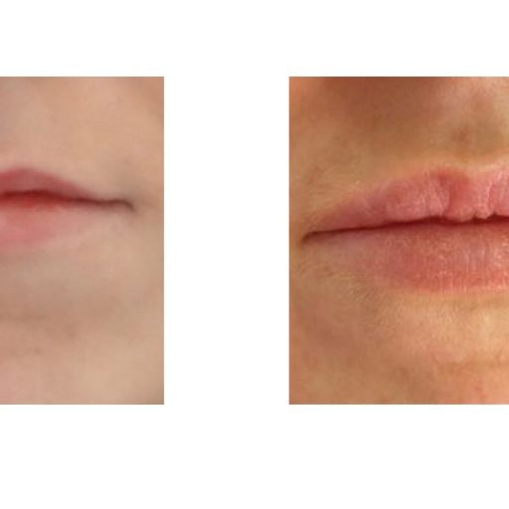 Lip Transformations: Why Lip Filler Might Be the Subtle Enhancement You Want