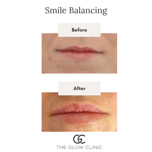 lip filler the glow clinic