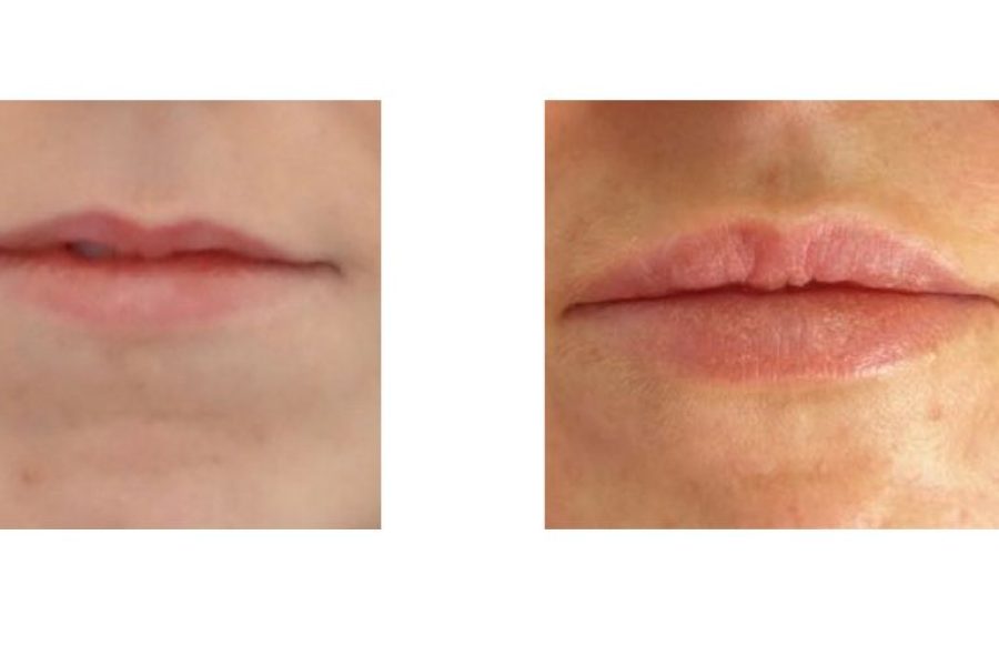 Lip Transformations: Why Lip Filler Might Be the Subtle Enhancement You Want