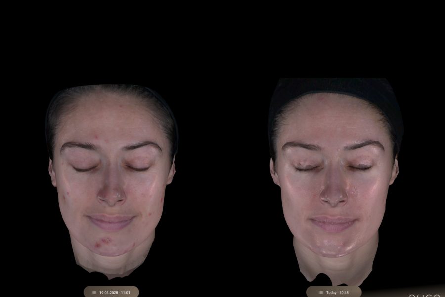 What to Expect After MOXI Laser Treatment: Downtime, Post-Care, and Results