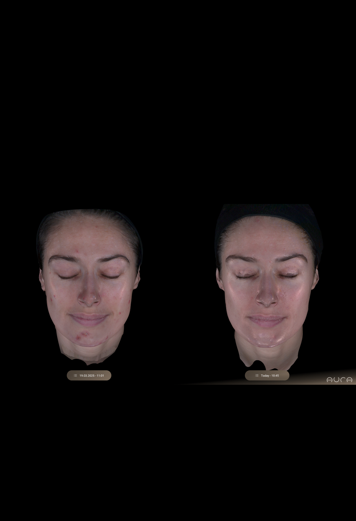 What to Expect After MOXI Laser Treatment: Downtime, Post-Care, and Results What to Expect After MOXI Laser Treatment: Downtime, Post-Care, and Results