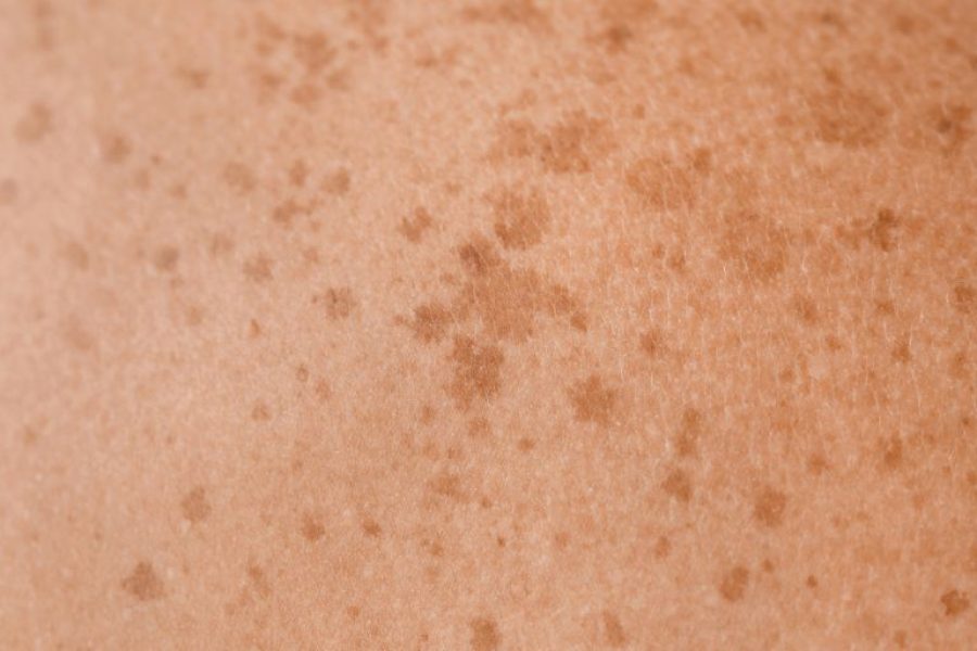 The Glow Guide to Melasma: What’s really behind the world’s most persistent pigment